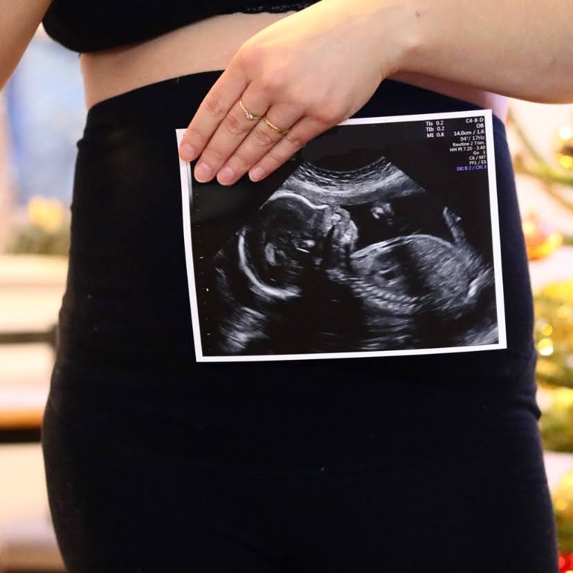 Cystická fibróza – naše výsledky a ultrazvuk z 22.&nbsp;týdne